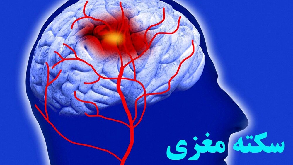 مهمترین علامت سکته مغزی/ زمان طلایی درمان سکته مغزی چقدر است؟ مهمترین علامت سکته مغزی/ زمان طلایی درمان سکته مغزی چقدر است؟