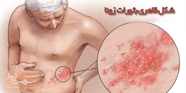 علل و علائم بیماری زونا چیست و چگونه درمان میشود؟