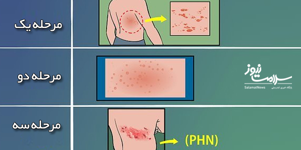 علل و علائم بیماری زونا چیست و چگونه درمان میشود؟