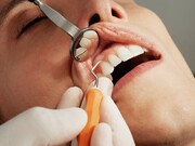 بهترین برند کامپوزیت دندان کدام است؟