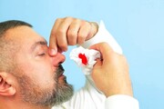 ۶ گام ساده برای کنترل خونریزی بینی در تابستان