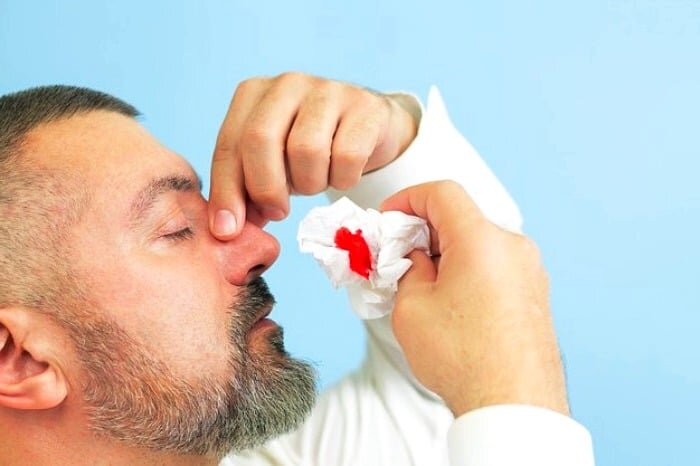 شایعترین علل خونریزی بینی؛ چه زمانی به پزشک مراجعه کنیم؟ شایعترین علل خونریزی بینی؛ چه زمانی به پزشک مراجعه کنیم؟
