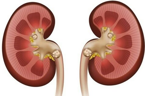 اینفوگرافیک/ ۸ عادت غلط که سبب بروز سنگ کلیه میشود اینفوگرافیک/ ۸ عادت غلط که سبب بروز سنگ کلیه میشود