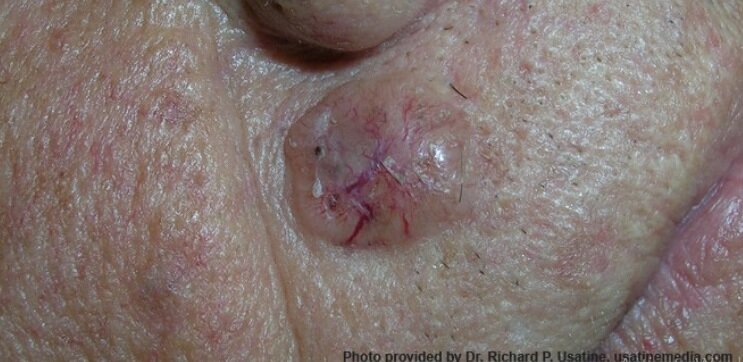 سرطان پوست 1