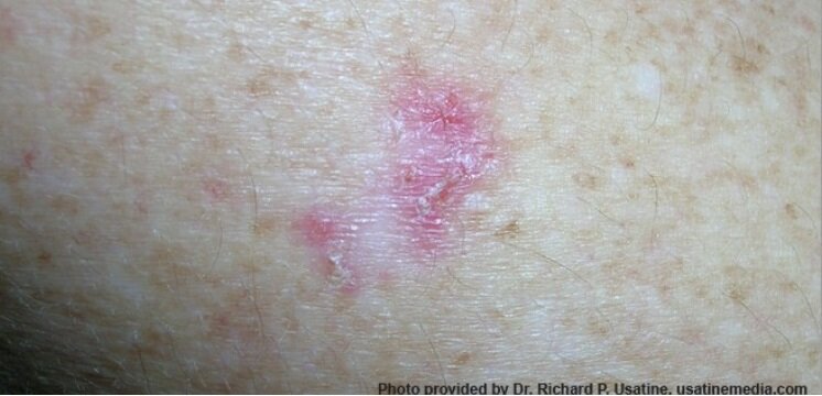 سرطان پوست 2