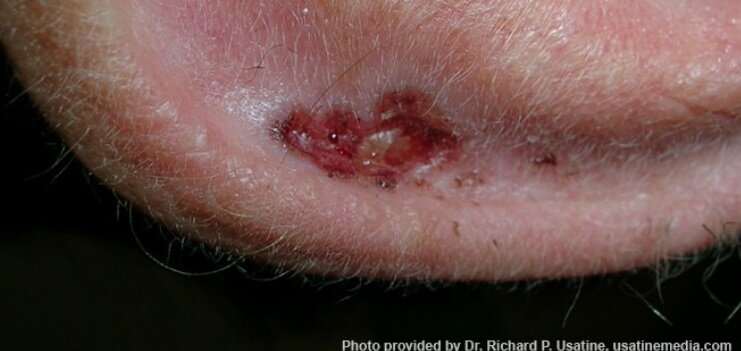 سرطان پوست 4