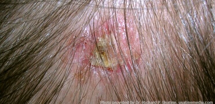 سرطان پوست 5