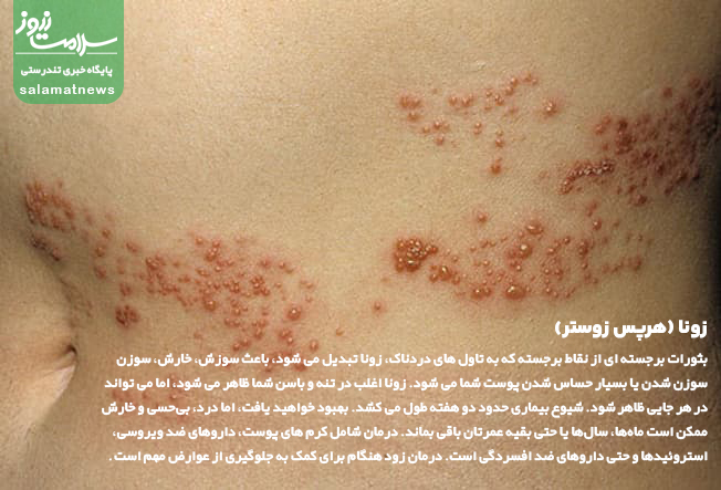 تصاویر انواع لکه های پوستی و روشهای درمان آنها