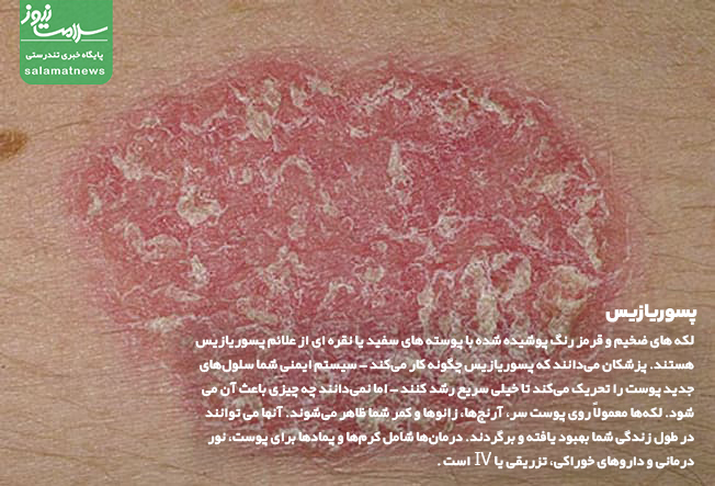 تصاویر انواع لکه های پوستی و روشهای درمان آنها