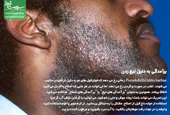 تصاویر انواع لکه های پوستی و روشهای درمان آنها