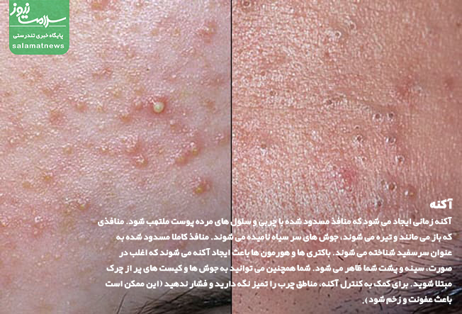 تصاویر انواع لکه های پوستی و روشهای درمان آنها