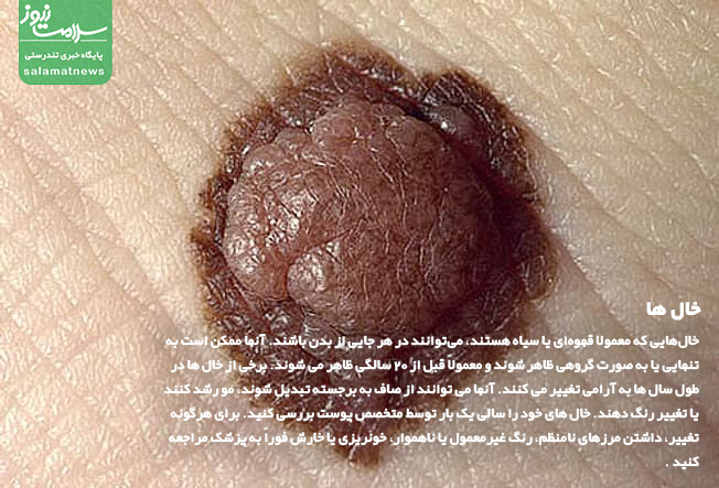 تصاویر انواع لکه های پوستی و روشهای درمان آنها