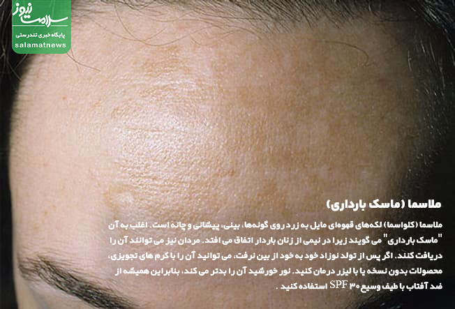 تصاویر انواع لکه های پوستی و روشهای درمان آنها