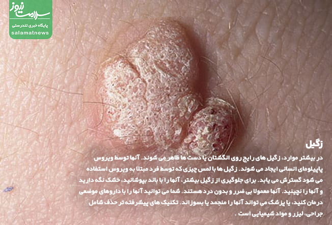 تصاویر انواع لکه های پوستی و روشهای درمان آنها
