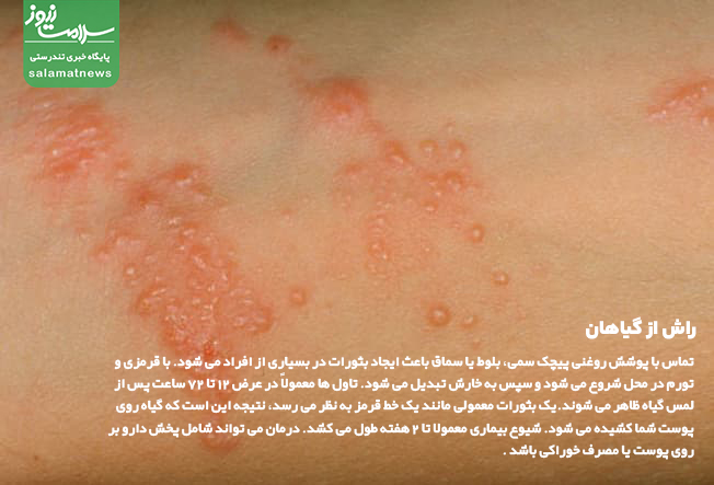 تصاویر انواع لکه های پوستی و روشهای درمان آنها