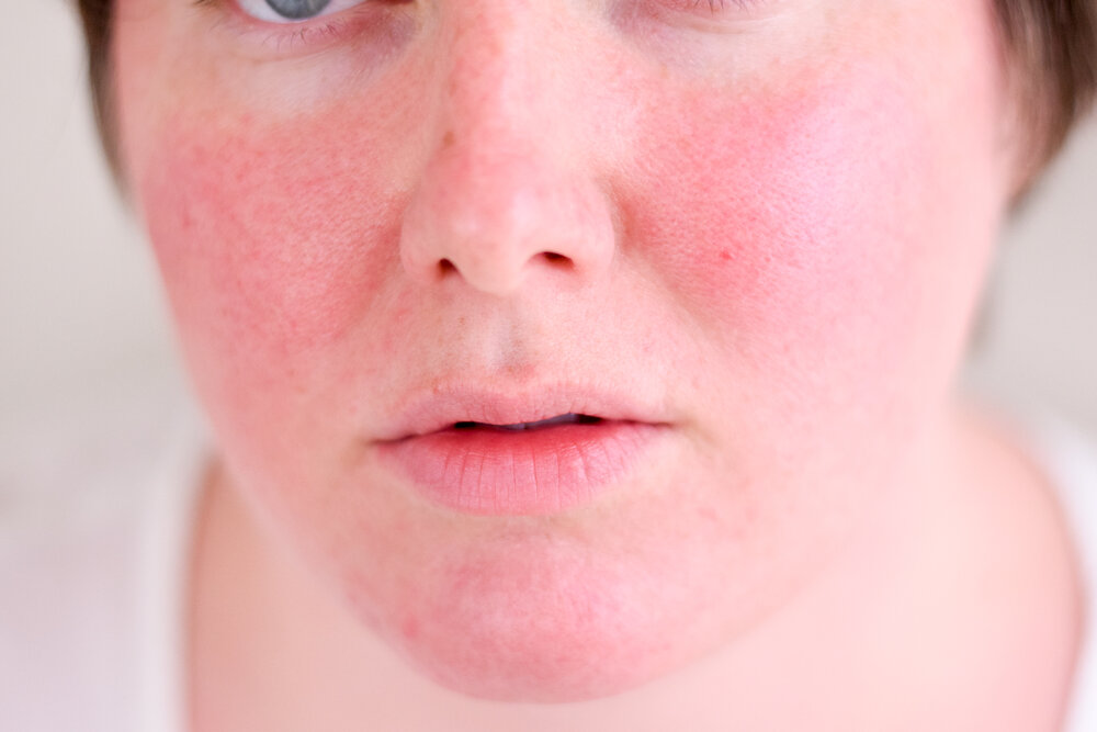 دلایل قرمز شدن ناگهانی پوست صورت و راه‌های درمان آن
