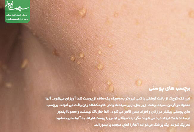 برچسب پوستی