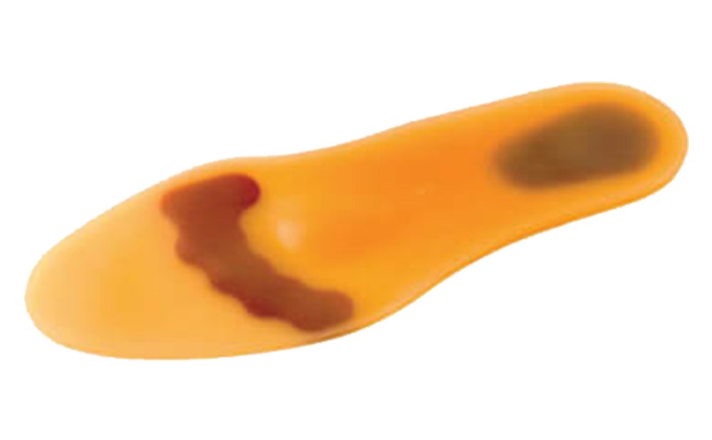 بهترین راه برای پیشگیری از قطع پا ناشی از زخم پای دیابتی