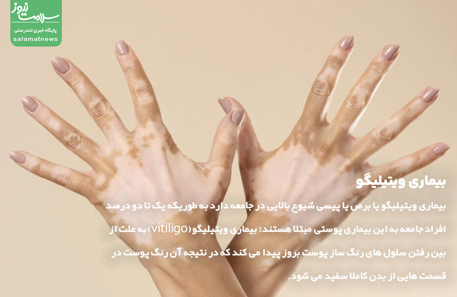 بیماری ویتیلیگو
