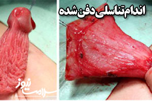 علائم و درمان  آلت تناسلی مخفی شده در پسر بچه ها+تصاویر