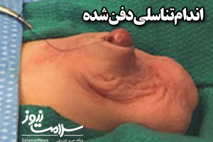علائم و درمان  آلت تناسلی مخفی شده در پسر بچه ها+تصاویر