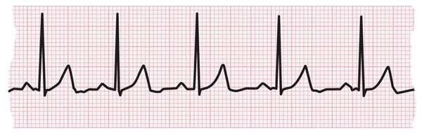 تاکی کاردی نرمال