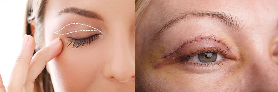 روشهای بالا کشیدن گوشه چشم و ابرو و مزایا و معایب هرکدام