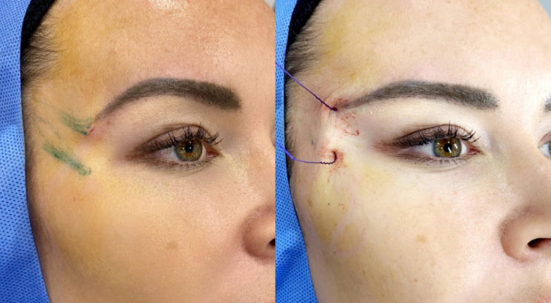 روشهای بالا کشیدن گوشه چشم و ابرو و مزایا و معایب هرکدام