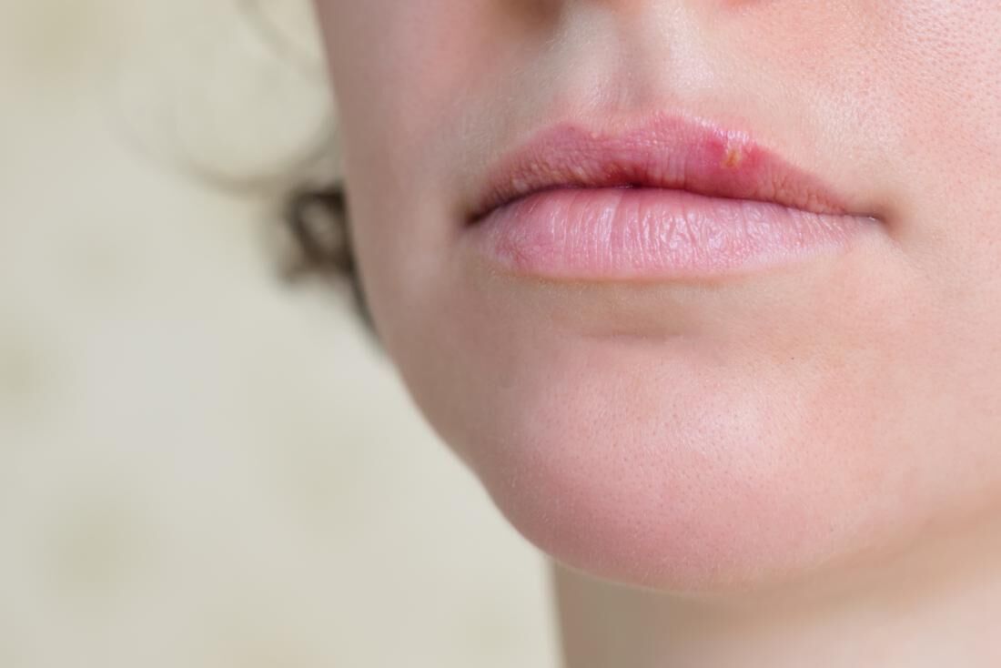 شایعترین و خطرناکترین بیماری های لب - سلامت نیوز