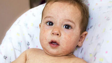 لکههای قرمز روی پوست کودکان نشانهای از بیماری پلاکتی است لکههای قرمز روی پوست کودکان نشانهای از بیماری پلاکتی است