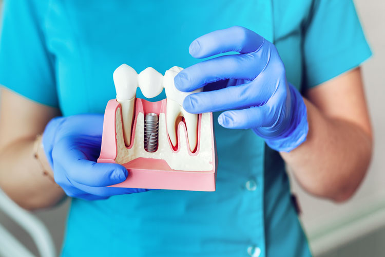 آیا ایمپلنت دندان مادام العمر است؟