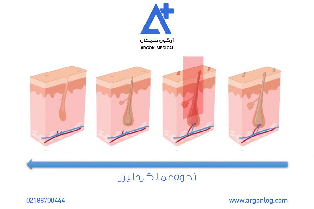 هر آنچه که باید در مورد تجربه لیزر موهای زائد بدانید
