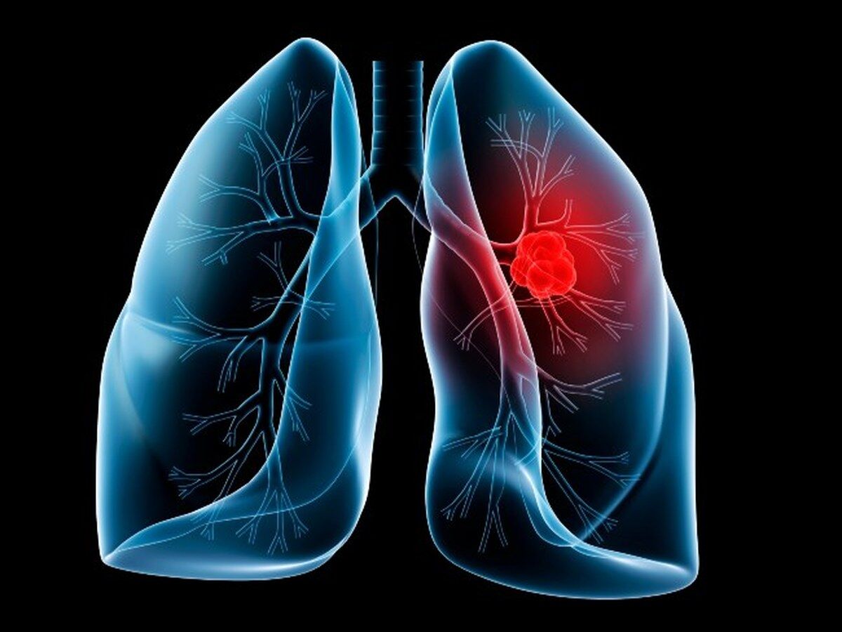 اینفوگرافیک / راه‌هایی برای مبارزه با برگشت سرطان ریه