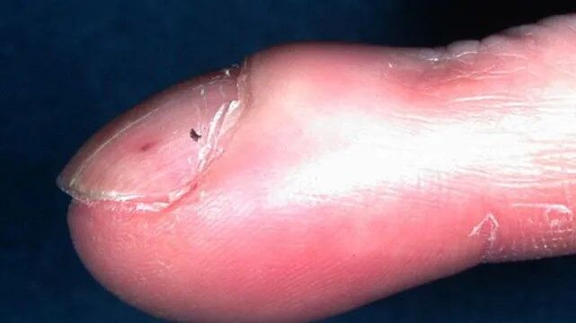 تشخیص بیماری ها از روی تغییرات ناخن