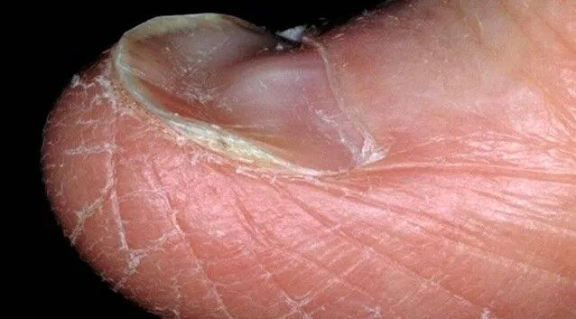 تشخیص بیماری ها از روی تغییرات ناخن