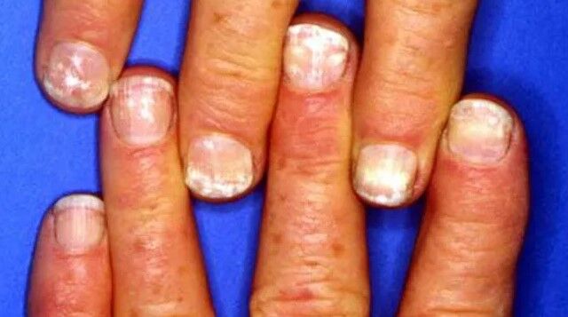 تشخیص بیماری ها از روی تغییرات ناخن