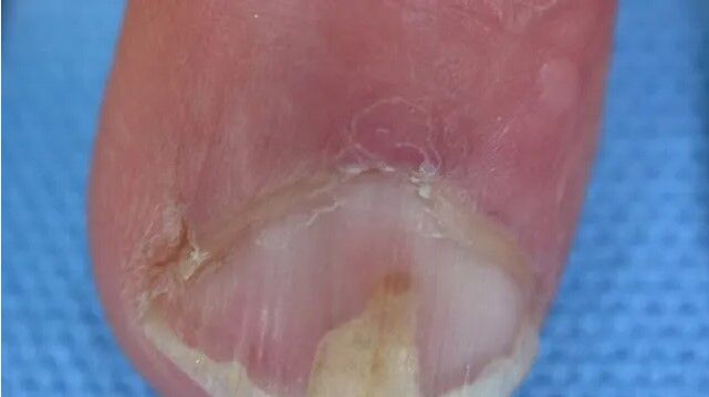 تشخیص بیماری ها از روی تغییرات ناخن