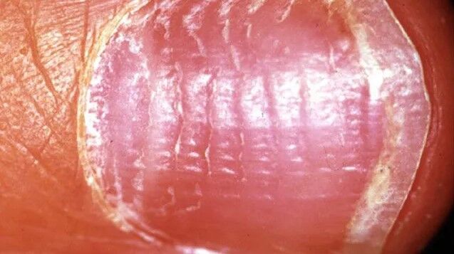 تشخیص بیماری ها از روی تغییرات ناخن