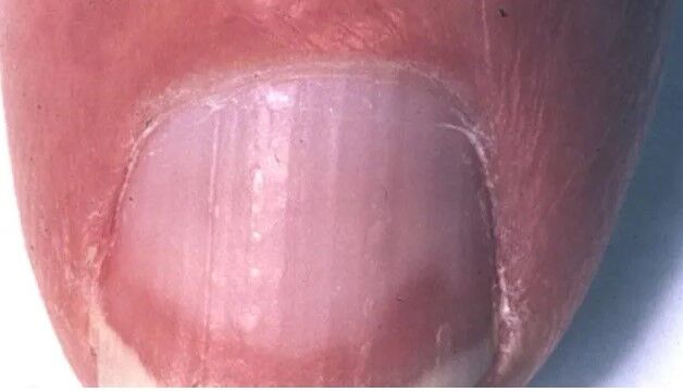 تشخیص بیماری ها از روی تغییرات ناخن