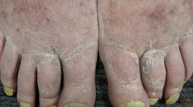 تشخیص بیماری ها از روی تغییرات ناخن