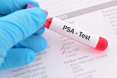 افزایش PSA همیشه به علت سرطان پروستات نیست
