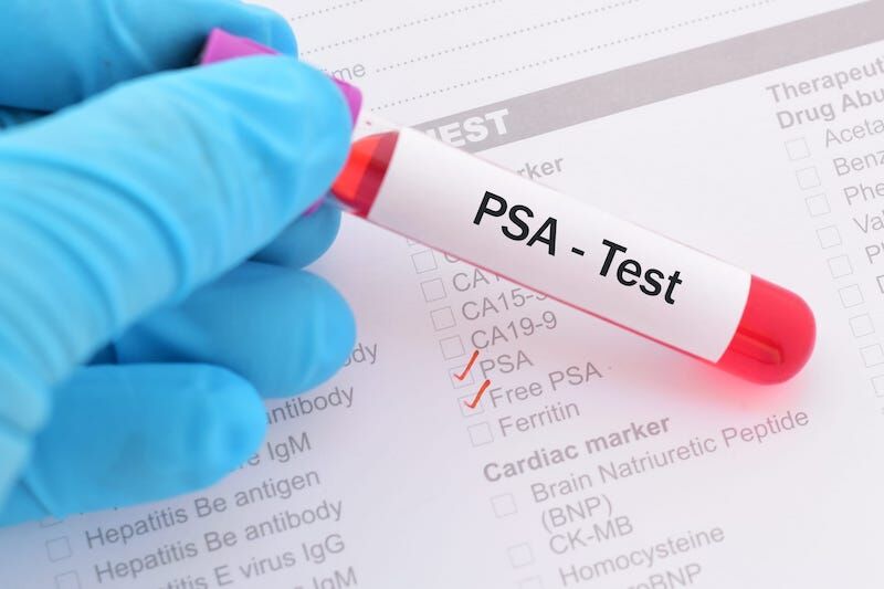 افزایش PSA همیشه به علت سرطان پروستات نیست