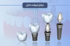 مراحل ایمپلنت دندان (کاشت دندان)