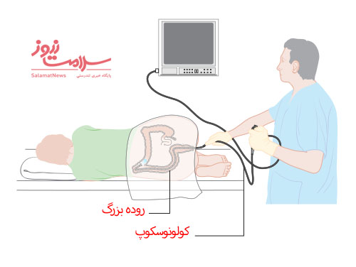 چه کسانی باید کولونوسکوپی شوند؟