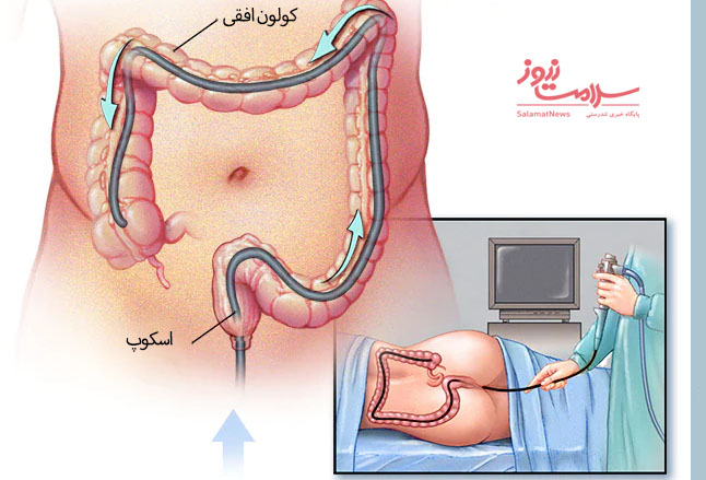 چه کسانی باید کولونوسکوپی شوند؟