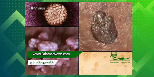 زگیل تناسلی چیست و چگونه درمان میشود؟