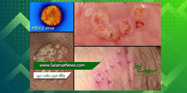 زگیل تناسلی چیست و چگونه درمان میشود؟