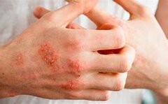 مشکلات پوستی می تواند اولین علامت بیماری های روماتولوژیک باشد