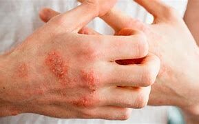 مشکلات پوستی می تواند اولین علامت بیماری های روماتولوژیک باشد