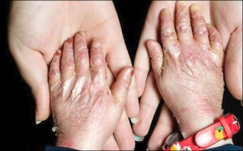 پانسمان حیاتی بیماران پروانه‌ای در فهرست تحریم‌هاست / هیچ کودک پروانه‌ای نباید از تحصیل بازبماند